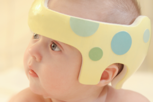 Baby with Plagiocephaly and Torticollis. Physical therapy for Torticollis can start as young as 4 weeks old. 